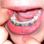Dental Braces Dental Braces