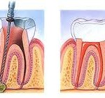 Root Canal Therapy