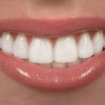 Porcelain Veneers