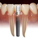 dental-implant-11