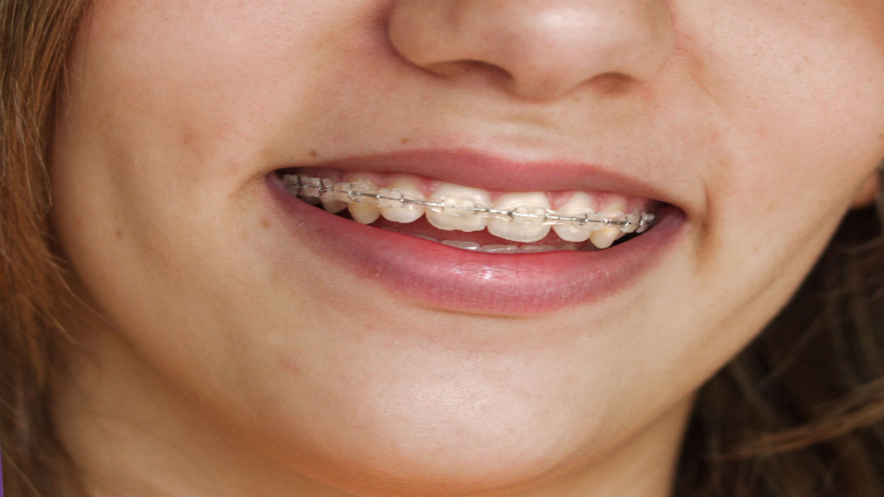 What Are Self-Ligating Dental Braces?