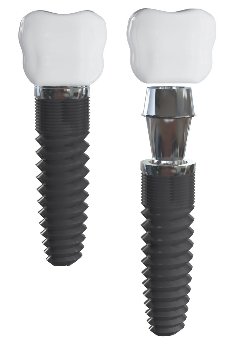 Why Dental Implants are the Perfect Solution to Replace Missing Teeth
