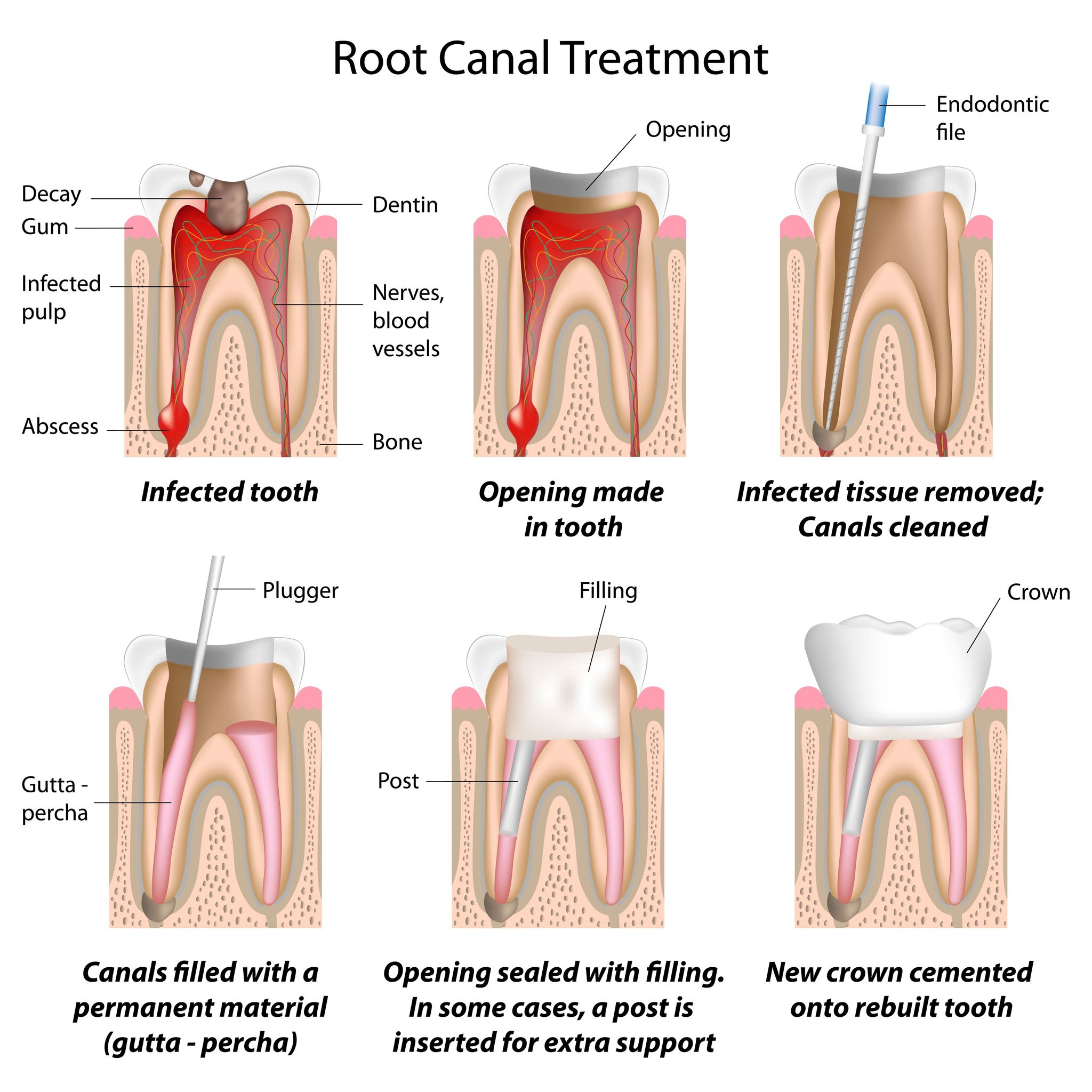 Signs That Root Canal Treatment Is Needed