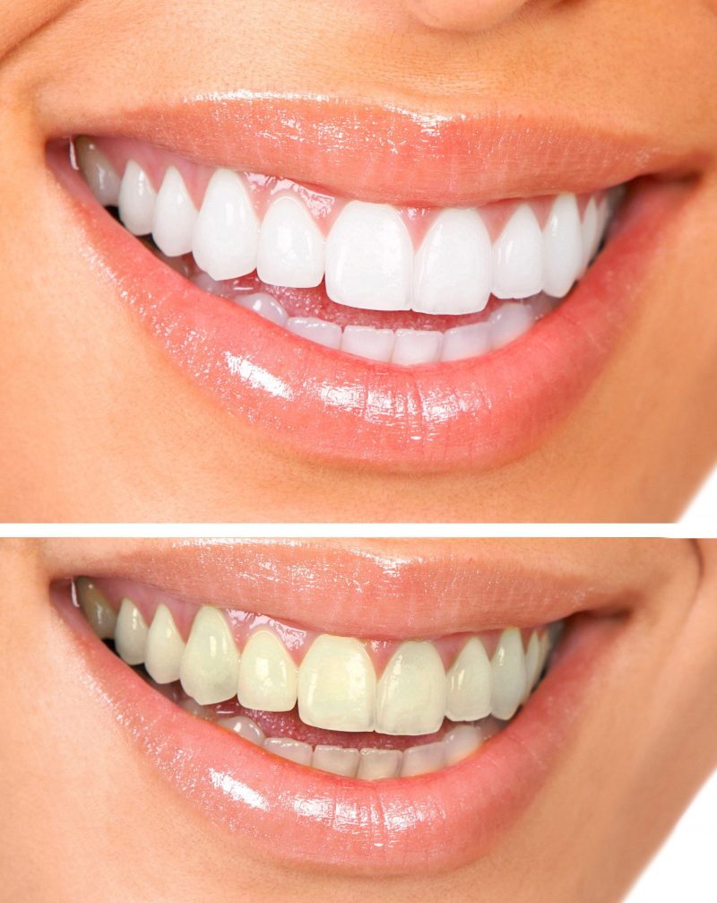 The Benefits Of Regular Teeth Cleaning In Salisbury NC
